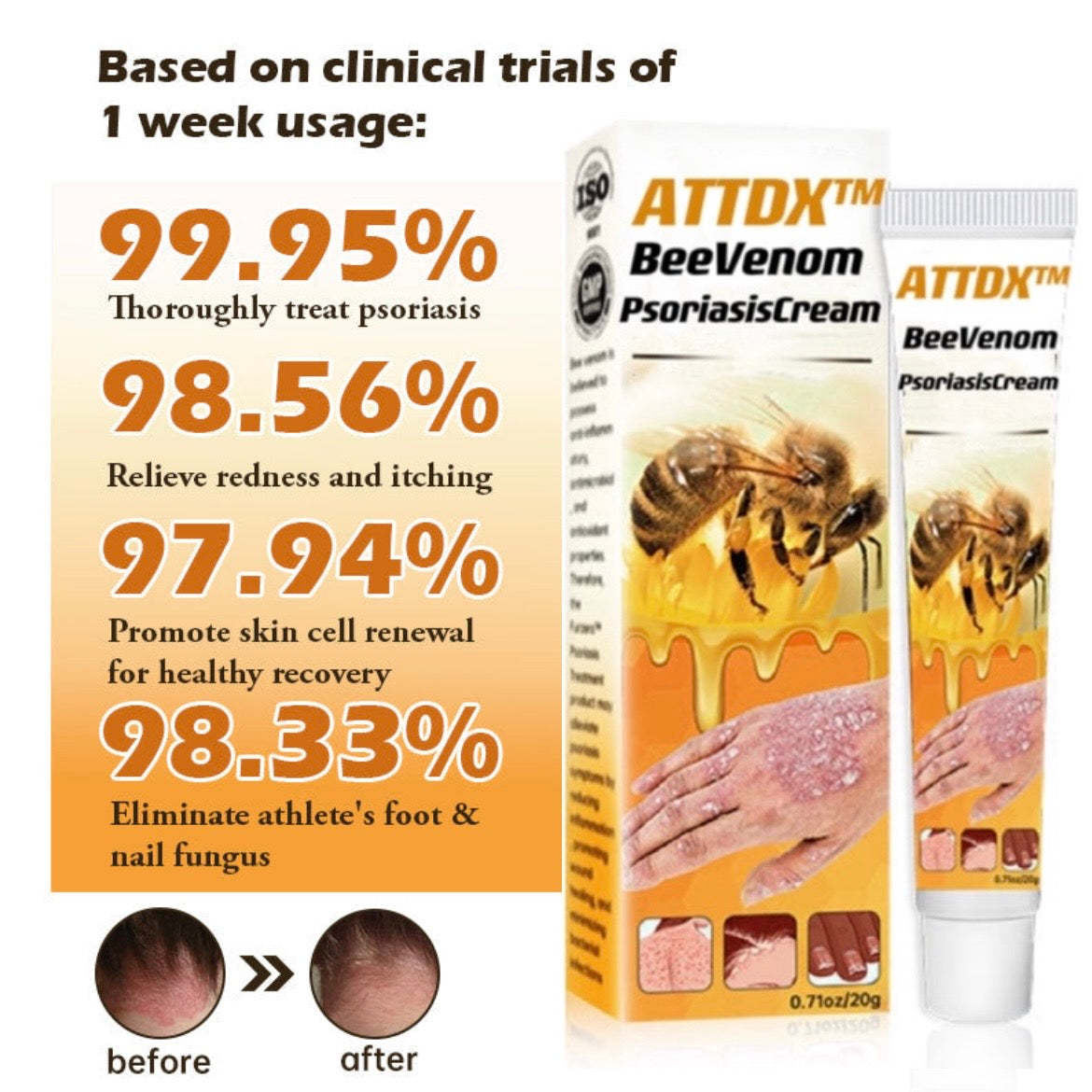 ATTDX™ BeeVenom PsoriasisCream